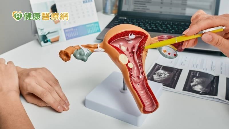 中年女子宮息肉手術3次又復發! 醫建議「1新式手術」10分鐘切除 中年女子宮息肉手術3次又復發! 醫建議「1新式手術」10分鐘切除